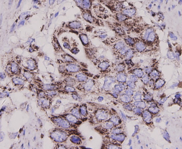 Immunohistochemical analysis of paraffin-embedded human stomach cancer tissue using anti-EGFR antibody. The section was pre-treated using heat mediated antigen retrieval with Tris-EDTA buffer (pH 8.0-8.4) for 20 minutes.The tissues were blocked in 5% BSA for 30 minutes at room temperature, washed with ddH2O and PBS, and then probed with the antibody (0407-21) at 1/200 dilution, for 30 minutes at room temperature and detected using an HRP conjugated compact polymer system. DAB was used as the chrogen. Counter stained with hematoxylin and mounted with DPX.