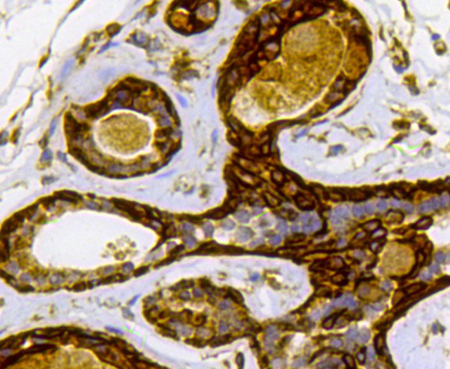 Immunohistochemical analysis of paraffin-embedded human breast carcinoma tissue using anti-Cytokeratin 17 antibody. The section was pre-treated using heat mediated antigen retrieval with Tris-EDTA buffer (pH 8.0-8.4) for 20 minutes.The tissues were blocked in 5% BSA for 30 minutes at room temperature, washed with ddH2O and PBS, and then probed with the antibody (0407-4) at 1/100 dilution, for 30 minutes at room temperature and detected using an HRP conjugated compact polymer system. DAB was used as the chrogen. Counter stained with hematoxylin and mounted with DPX.
