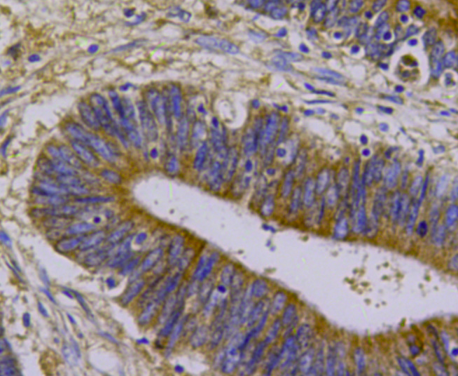 Immunohistochemical analysis of paraffin-embedded human colon cancer tissue using anti-Beta III Tubulin antibody. Counter stained with hematoxylin.