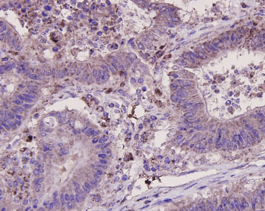 Immunohistochemical analysis of paraffin-embedded human colon cancer tissue using anti-Osteopontin antibody. The section was pre-treated using heat mediated antigen retrieval with sodium citrate buffer (pH 6.0) for 20 minutes. The tissues were blocked in 5% BSA for 30 minutes at room temperature, washed with ddH2O and PBS, and then probed with the primary antibody (0806-8, 1/400) for 30 minutes at room temperature. The detection was performed using an HRP conjugated compact polymer system. DAB was used as the chromogen. Tissues were counterstained with hematoxylin and mounted with DPX.