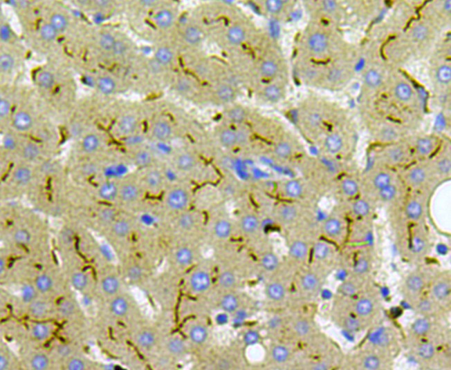 Immunohistochemical analysis of paraffin-embedded human liver cancer tissue using anti-Carcino Embryonic Antigen CEA antibody. The section was pre-treated using heat mediated antigen retrieval with Tris-EDTA buffer (pH 8.0-8.4) for 20 minutes.The tissues were blocked in 5% BSA for 30 minutes at room temperature, washed with ddH2O and PBS, and then probed with the antibody (0807-10) at 1/100 dilution, for 30 minutes at room temperature and detected using an HRP conjugated compact polymer system. DAB was used as the chrogen. Counter stained with hematoxylin and mounted with DPX.