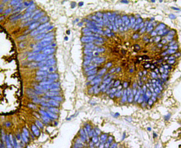 Immunohistochemical analysis of paraffin-embedded human colon cancer tissue using anti-Carcino Embryonic Antigen CEA antibody. The section was pre-treated using heat mediated antigen retrieval with Tris-EDTA buffer (pH 8.0-8.4) for 20 minutes.The tissues were blocked in 5% BSA for 30 minutes at room temperature, washed with ddH2O and PBS, and then probed with the antibody (0807-10) at 1/100 dilution, for 30 minutes at room temperature and detected using an HRP conjugated compact polymer system. DAB was used as the chrogen. Counter stained with hematoxylin and mounted with DPX.