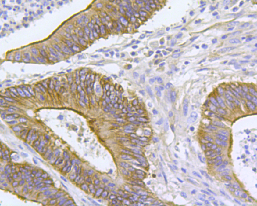 Immunohistochemical analysis of paraffin-embedded human colon cancer tissue using anti-ARF1 antibody. The section was pre-treated using heat mediated antigen retrieval with Tris-EDTA buffer (pH 8.0-8.4) for 20 minutes.The tissues were blocked in 5% BSA for 30 minutes at room temperature, washed with ddH2O and PBS, and then probed with the primary antibody (0807-7, 1/100) for 30 minutes at room temperature. The detection was performed using an HRP conjugated compact polymer system. DAB was used as the chromogen. Tissues were counterstained with hematoxylin and mounted with DPX.