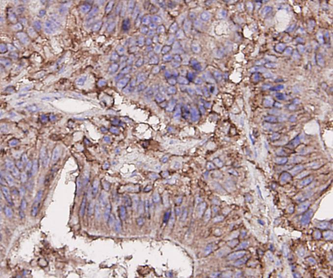 Immunohistochemical analysis of paraffin-embedded human colon carcinoma tissue using anti-CD44 antibody. Counter stained with hematoxylin.