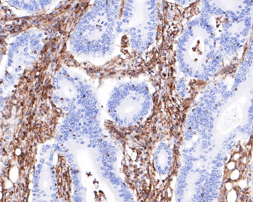 Immunohistochemical analysis of paraffin-embedded human colon carcinoma tissue using anti-Vimentin antibody. The section was pre-treated using heat mediated antigen retrieval with Tris-EDTA buffer (pH 9.0) for 20 minutes.The tissues were blocked in 5% BSA for 30 minutes at room temperature, washed with ddH2O and PBS, and then probed with the primary antibody (EM0401, 1/800) for 30 minutes at room temperature. The detection was performed using an HRP conjugated compact polymer system. DAB was used as the chromogen. Tissues were counterstained with hematoxylin and mounted with DPX.