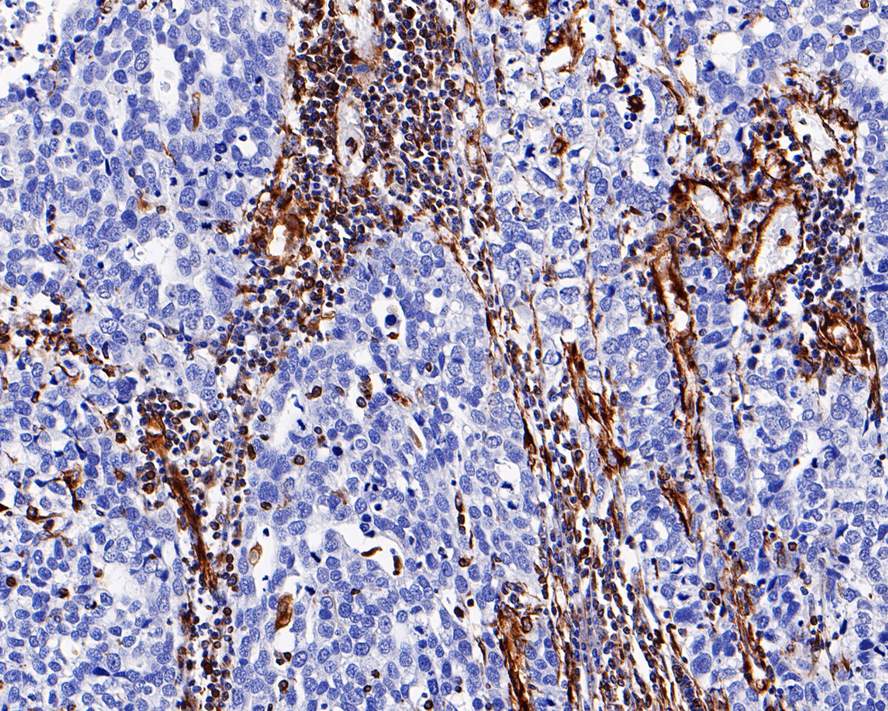 Immunohistochemical analysis of paraffin-embedded human stomach carcinoma tissue using anti-Vimentin antibody. The section was pre-treated using heat mediated antigen retrieval with Tris-EDTA buffer (pH 9.0) for 20 minutes.The tissues were blocked in 5% BSA for 30 minutes at room temperature, washed with ddH2O and PBS, and then probed with the primary antibody (EM0401, 1/800) for 30 minutes at room temperature. The detection was performed using an HRP conjugated compact polymer system. DAB was used as the chromogen. Tissues were counterstained with hematoxylin and mounted with DPX.
