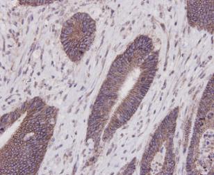 Immunohistochemical analysis of paraffin-embedded human liver carcinoma tissue using anti-E-Cadherin antibody. The section was pre-treated using heat mediated antigen retrieval with Tris-EDTA buffer (pH 9.0) for 20 minutes.The tissues were blocked in 1% BSA for 30 minutes at room temperature, washed with ddH2O and PBS, and then probed with the primary antibody (EM0502, 1/50) for 30 minutes at room temperature. The detection was performed using an HRP conjugated compact polymer system. DAB was used as the chromogen. Tissues were counterstained with hematoxylin and mounted with DPX.