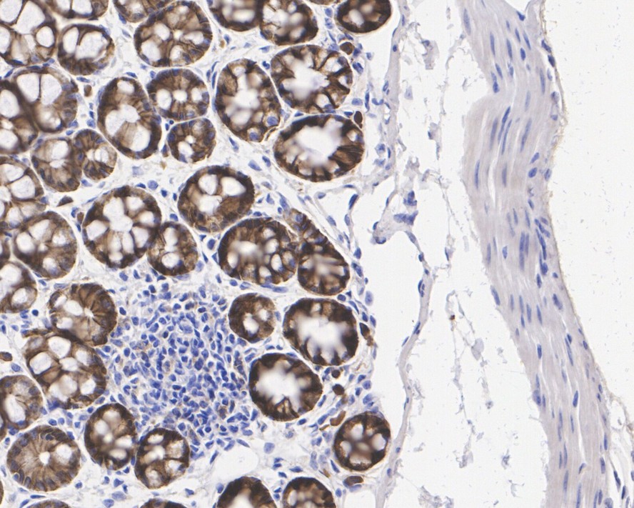 Immunohistochemical analysis of paraffin-embedded human colon carcinoma tissue using anti-E-Cadherin antibody. The section was pre-treated using heat mediated antigen retrieval with Tris-EDTA buffer (pH 9.0) for 20 minutes.The tissues were blocked in 1% BSA for 30 minutes at room temperature, washed with ddH2O and PBS, and then probed with the primary antibody (EM0502, 1/50) for 30 minutes at room temperature. The detection was performed using an HRP conjugated compact polymer system. DAB was used as the chromogen. Tissues were counterstained with hematoxylin and mounted with DPX.