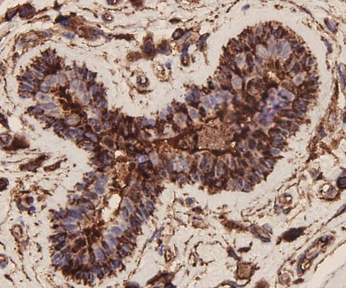 Immunohistochemical analysis of paraffin-embedded human breast carcinoma tissue using EpCAM antibody. Counter stained with hematoxylin.