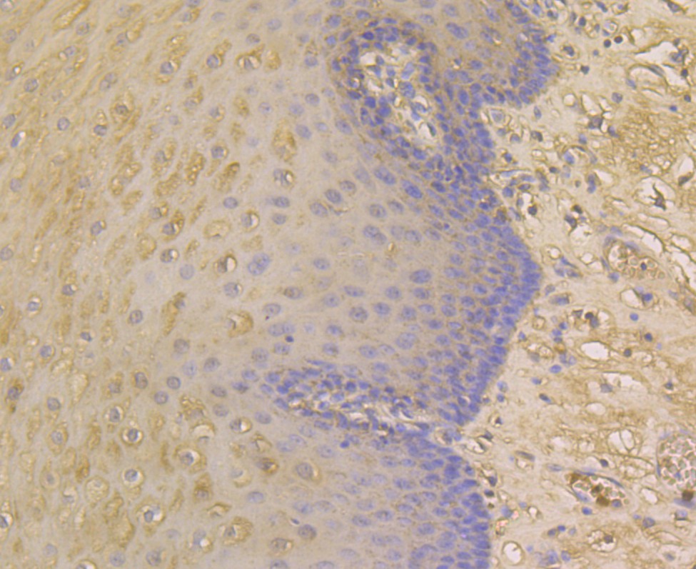 Immunohistochemical analysis of paraffin-embedded human esophagus tissue using anti- Alpha-1-acid glycoprotein antibody. Counter stained with hematoxylin.
