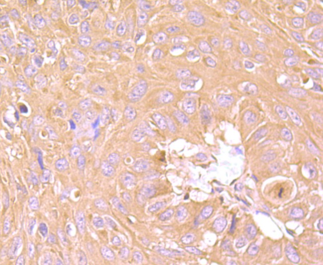 Immunohistochemical analysis of paraffin-embedded human lung cancer tissue using anti-Tim3 antibody. Counter stained with hematoxylin.