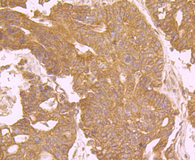 Immunohistochemical analysis of paraffin-embedded human stomach cancer tissue using anti-EGFR antibody. Counter stained with hematoxylin.