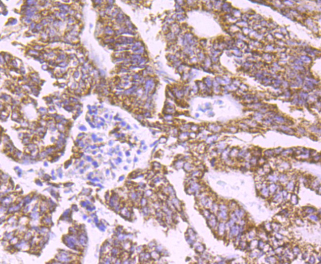 Immunohistochemical analysis of paraffin-embedded human liver tissue using anti-PCSK9 antibody. Counter stained with hematoxylin.