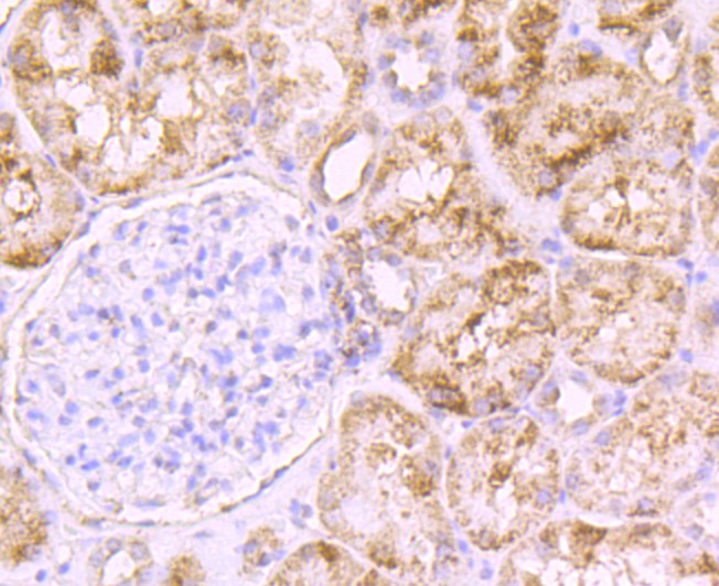 Immunohistochemical analysis of paraffin-embedded human colon caner tissue using anti-PCSK9 antibody. Counter stained with hematoxylin.