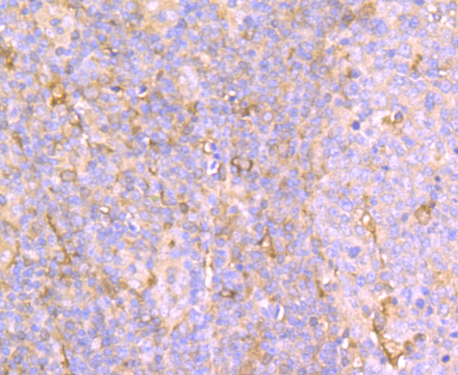 Immunohistochemical analysis of paraffin-embedded human lung cancer tissue using anti-AFP antibody. Counter stained with hematoxylin.