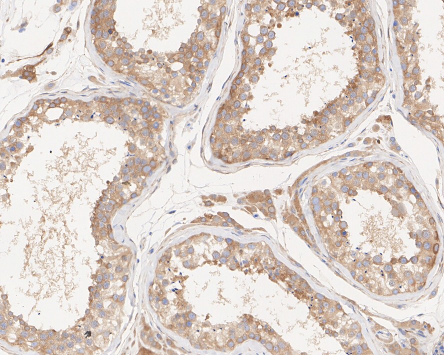 Immunohistochemical analysis of paraffin-embedded human thyroid gland tissue using anti-B Raf antibody. Counter stained with hematoxylin.