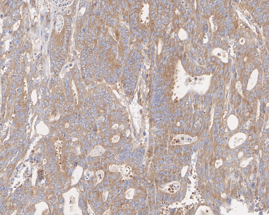 Immunohistochemical analysis of paraffin-embedded human colon cancer tissue using anti-B Raf antibody. Counter stained with hematoxylin.