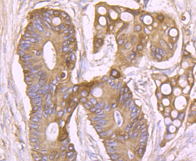 Immunohistochemical analysis of paraffin-embedded human colon cancer tissue using anti-NaV1.7 antibody. Counter stained with hematoxylin.