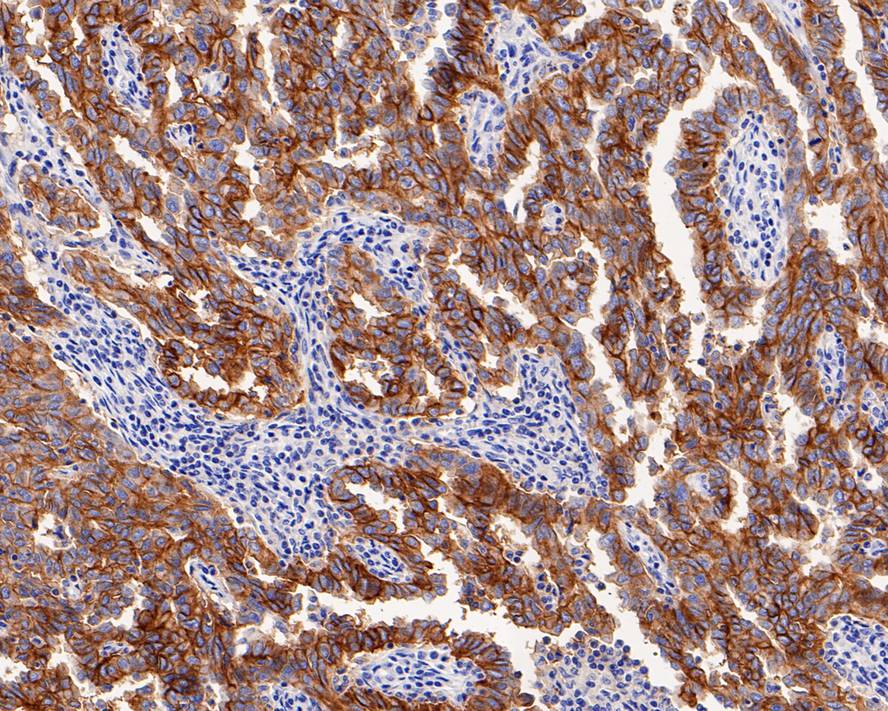 Immunohistochemical analysis of paraffin-embedded human ovarian carcinoma tissue with Mouse anti-CD47 antibody (EM1701-38) at 1/1,000 dilution.<br />
<br />
The section was pre-treated using heat mediated antigen retrieval with Tris-EDTA buffer (pH 9.0) for 20 minutes. The tissues were blocked in 1% BSA for 20 minutes at room temperature, washed with ddH2O and PBS, and then probed with the primary antibody (EM1701-38) at 1/1,000 dilution for 1 hour at room temperature. The detection was performed using an HRP conjugated compact polymer system. DAB was used as the chromogen. Tissues were counterstained with hematoxylin and mounted with DPX.
