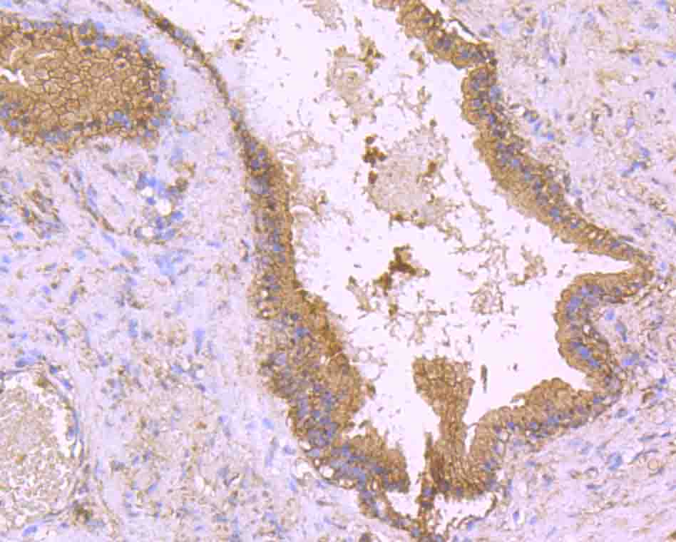 Immunohistochemical analysis of paraffin-embedded human prostate tissue using anti-CD130 antibody. Counter stained with hematoxylin.