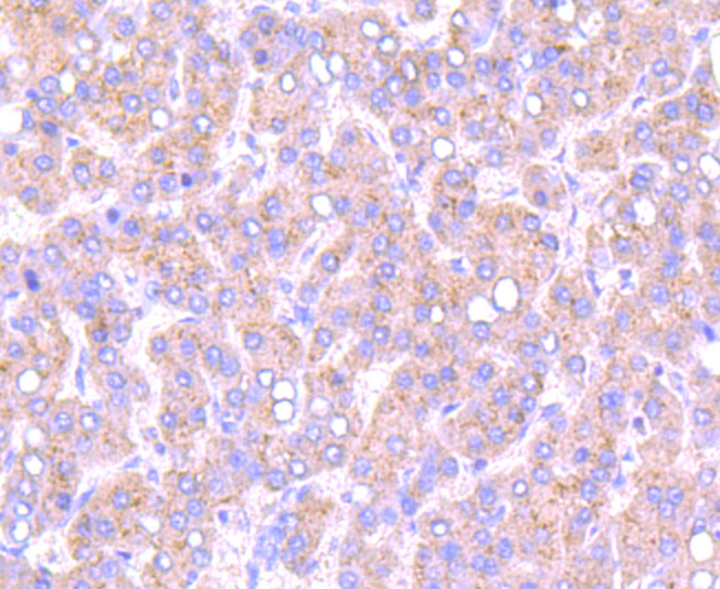 Immunohistochemical analysis of paraffin-embedded human liver cancer tissue using anti-Smad2 antibody. Counter stained with hematoxylin.