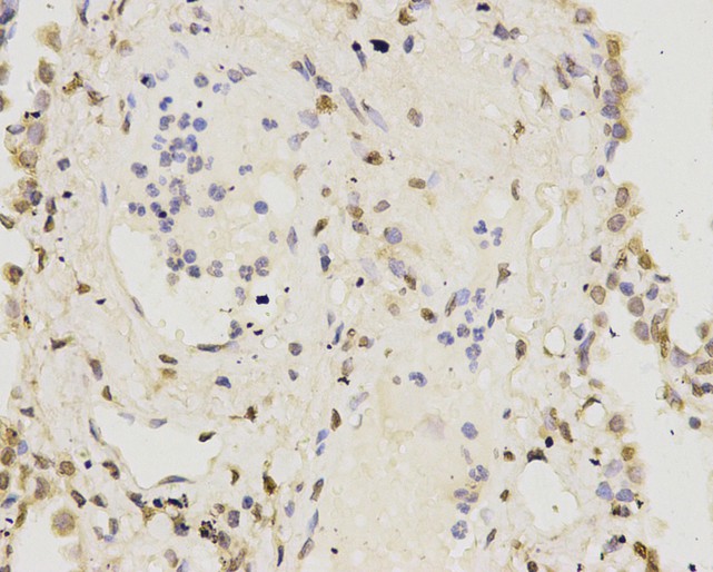 Immunohistochemical analysis of paraffin-embedded human lung tissue using anti- IFNAR1 antibody. Counter stained with hematoxylin.