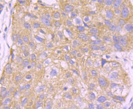 Immunohistochemical analysis of paraffin-embedded human lung carcinoma tissue using anti-UAP1 antibody. The section was pre-treated using heat mediated antigen retrieval with Tris-EDTA buffer (pH 8.0-8.4) for 20 minutes.The tissues were blocked in 5% BSA for 30 minutes at room temperature, washed with ddH2O and PBS, and then probed with the primary antibody (EM1701-50, 1/50) for 30 minutes at room temperature. The detection was performed using an HRP conjugated compact polymer system. DAB was used as the chromogen. Tissues were counterstained with hematoxylin and mounted with DPX.