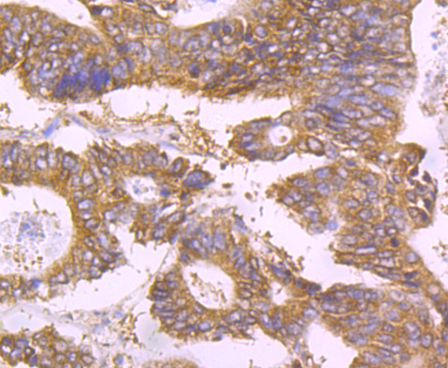 Immunohistochemical analysis of paraffin-embedded human colon carcinoma tissue using anti-UAP1 antibody. The section was pre-treated using heat mediated antigen retrieval with Tris-EDTA buffer (pH 8.0-8.4) for 20 minutes.The tissues were blocked in 5% BSA for 30 minutes at room temperature, washed with ddH2O and PBS, and then probed with the primary antibody (EM1701-50, 1/50) for 30 minutes at room temperature. The detection was performed using an HRP conjugated compact polymer system. DAB was used as the chromogen. Tissues were counterstained with hematoxylin and mounted with DPX.