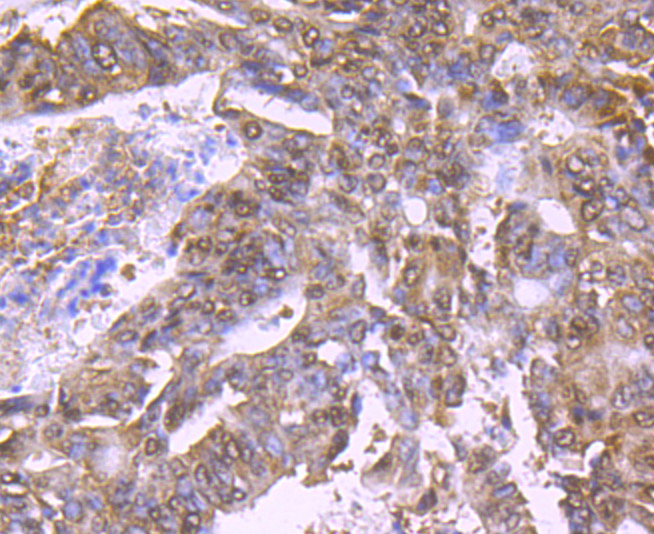 Immunohistochemical analysis of paraffin-embedded human colon cancer tissue using anti-Bmi1 antibody. Counter stained with hematoxylin.