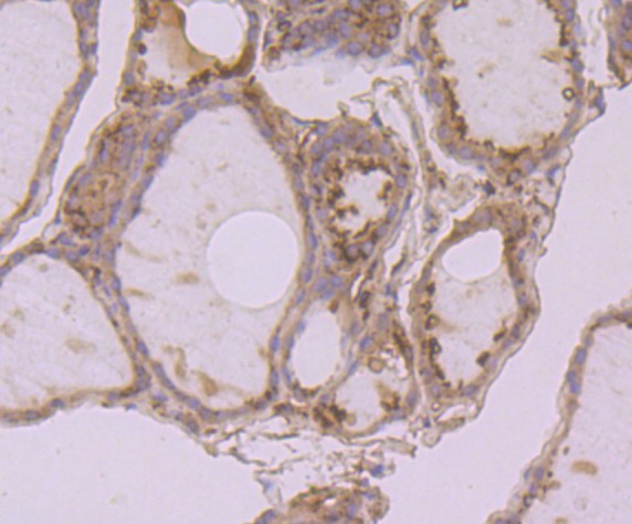 Immunohistochemical analysis of paraffin-embedded human prostate cancer tissue using anti-Calreticulin antibody. Counter stained with hematoxylin.