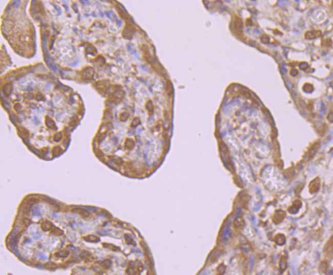 Immunohistochemical analysis of paraffin-embedded human colon cancer tissue using anti-PI 3 Kinase p85 alpha antibody. Counter stained with hematoxylin.
