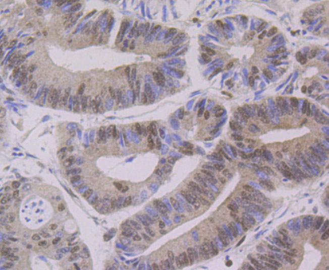 Immunohistochemical analysis of paraffin-embedded human colon cancer tissue using anti-PTBP1 antibody. Counter stained with hematoxylin.