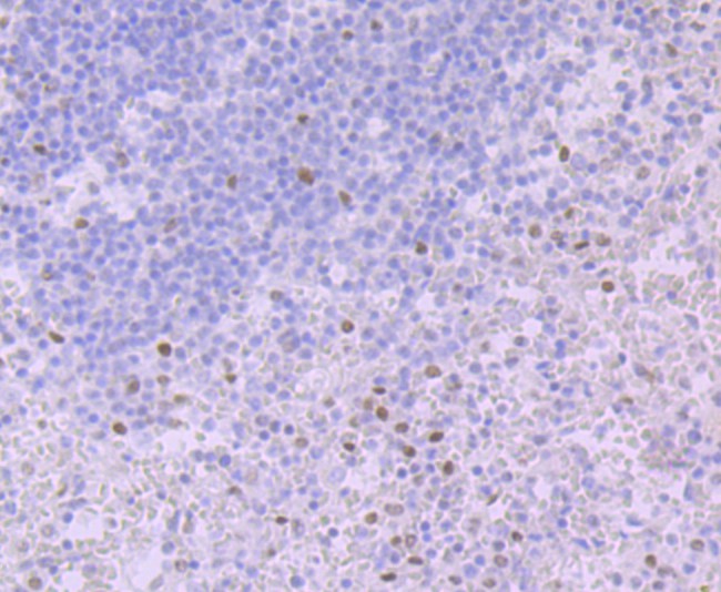 Immunohistochemical analysis of paraffin-embedded human breast cancer tissue using anti-Glucocorticoid Receptor alpha antibody. Counter stained with hematoxylin.