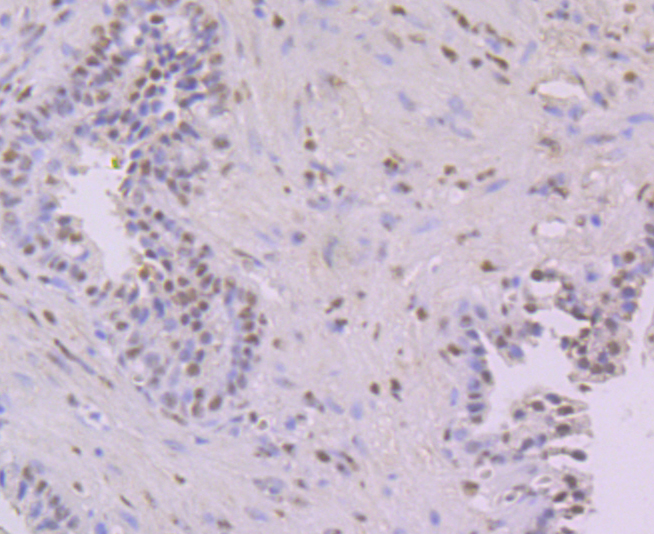 Immunohistochemical analysis of paraffin-embedded human prostate tissue using anti-NFIB/NF1B2 antibody. Counter stained with hematoxylin.