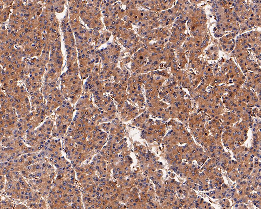 Immunohistochemical analysis of paraffin-embedded human liver cancer tissue using anti- Peroxiredoxin 2 antibody. Counter stained with hematoxylin.