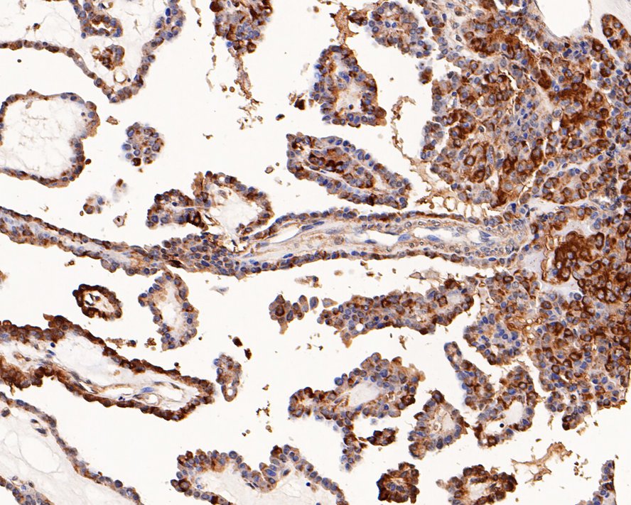 Immunohistochemical analysis of paraffin-embedded human thyroid carcinoma tissue with Mouse anti-PRDX2 antibody (EM1701-70) at 1/200 dilution.<br />
<br />
The section was pre-treated using heat mediated antigen retrieval with Tris-EDTA buffer (pH 9.0) for 20 minutes. The tissues were blocked in 1% BSA for 20 minutes at room temperature, washed with ddH2O and PBS, and then probed with the primary antibody (EM1701-70) at 1/200 dilution for 1 hour at room temperature. The detection was performed using an HRP conjugated compact polymer system. DAB was used as the chromogen. Tissues were counterstained with hematoxylin and mounted with DPX.