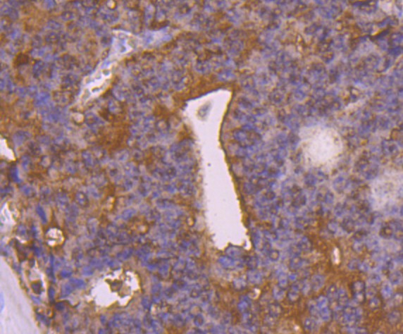 Immunohistochemical analysis of paraffin-embedded human prostate cancer tissue using anti- Peroxiredoxin 2 antibody. Counter stained with hematoxylin.