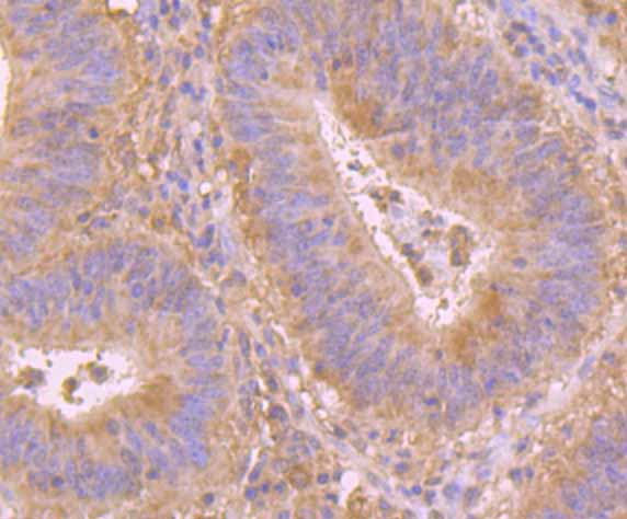 Immunohistochemical analysis of paraffin-embedded human colon cancer tissue using anti-PRDX6 antibody. Counter stained with hematoxylin.