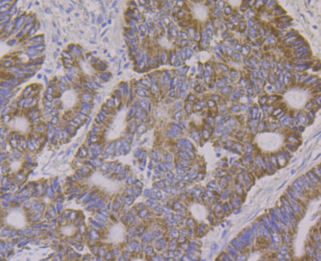 Immunohistochemical analysis of paraffin-embedded human colon cancer tissue using anti-ALDH4A1 antibody. Counter stained with hematoxylin.