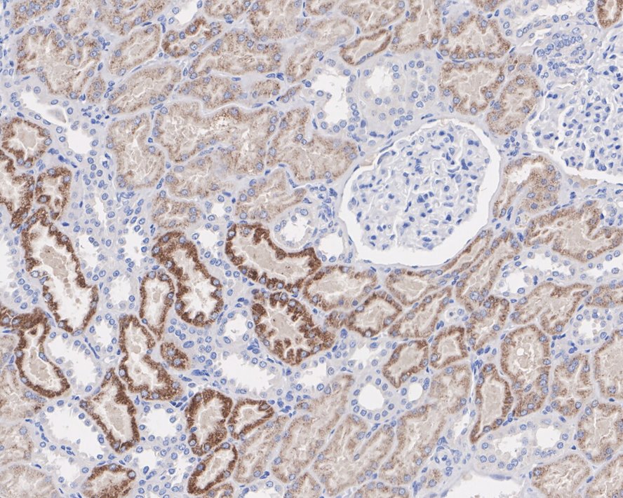 Immunohistochemical analysis of paraffin-embedded human liver carcinoma tissue using anti-AMACR/P504S antibody. The section was pre-treated using heat mediated antigen retrieval with Tris-EDTA buffer (pH 8.0-8.4) for 20 minutes.The tissues were blocked in 5% BSA for 30 minutes at room temperature, washed with ddH2O and PBS, and then probed with the primary antibody (EM1701-80, 1/50) for 30 minutes at room temperature. The detection was performed using an HRP conjugated compact polymer system. DAB was used as the chromogen. Tissues were counterstained with hematoxylin and mounted with DPX.