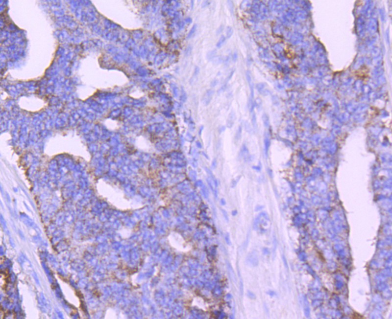 Immunohistochemical analysis of paraffin-embedded human kidney tissue using anti-AMACR/P504S antibody. The section was pre-treated using heat mediated antigen retrieval with Tris-EDTA buffer (pH 8.0-8.4) for 20 minutes.The tissues were blocked in 5% BSA for 30 minutes at room temperature, washed with ddH2O and PBS, and then probed with the primary antibody (EM1701-80, 1/50) for 30 minutes at room temperature. The detection was performed using an HRP conjugated compact polymer system. DAB was used as the chromogen. Tissues were counterstained with hematoxylin and mounted with DPX.