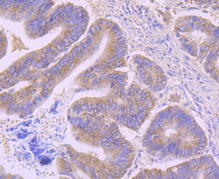 Immunohistochemical analysis of paraffin-embedded human colon carcinoma tissue using anti-AMACR/P504S antibody. The section was pre-treated using heat mediated antigen retrieval with Tris-EDTA buffer (pH 8.0-8.4) for 20 minutes.The tissues were blocked in 5% BSA for 30 minutes at room temperature, washed with ddH2O and PBS, and then probed with the primary antibody (EM1701-80, 1/50) for 30 minutes at room temperature. The detection was performed using an HRP conjugated compact polymer system. DAB was used as the chromogen. Tissues were counterstained with hematoxylin and mounted with DPX.