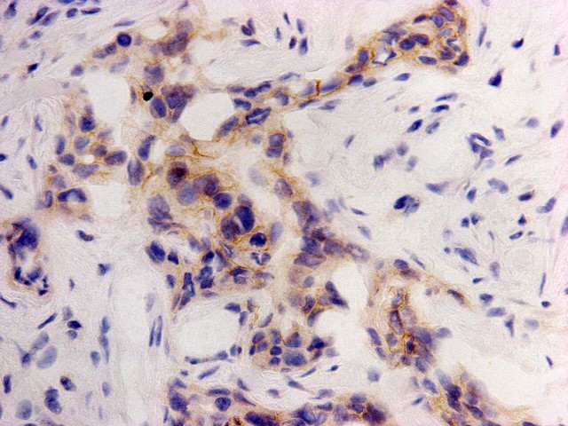 Immunohistochemical analysis of paraffin-embedded human breast cancer tissue using anti-CDCP1 antibody. Counter stained with hematoxylin.