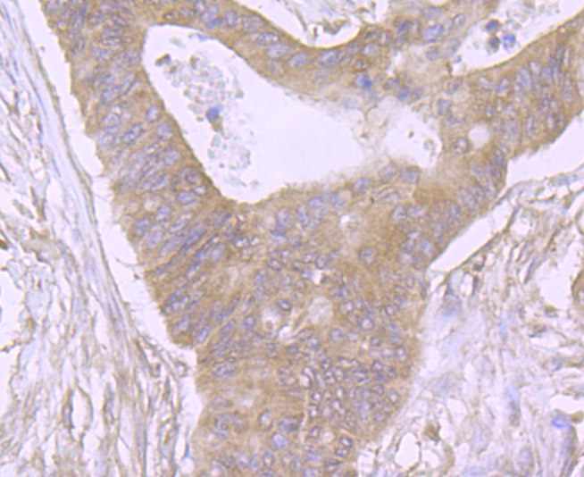 Immunohistochemical analysis of paraffin-embedded human colon cancer tissue using anti-CDCP1 antibody. Counter stained with hematoxylin.