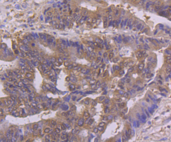 Immunohistochemical analysis of paraffin-embedded human colon cancer tissue using anti-NFIB/NF1B2 antibody. Counter stained with hematoxylin.