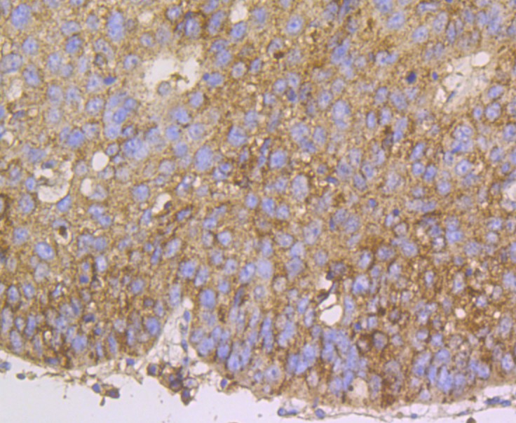 Immunohistochemical analysis of paraffin-embedded human lung cancer tissue using anti-ERp72 antibody. Counter stained with hematoxylin.