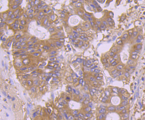 Immunohistochemical analysis of paraffin-embedded human colon cancer tissue using anti-Calpain 1 antibody. Counter stained with hematoxylin.