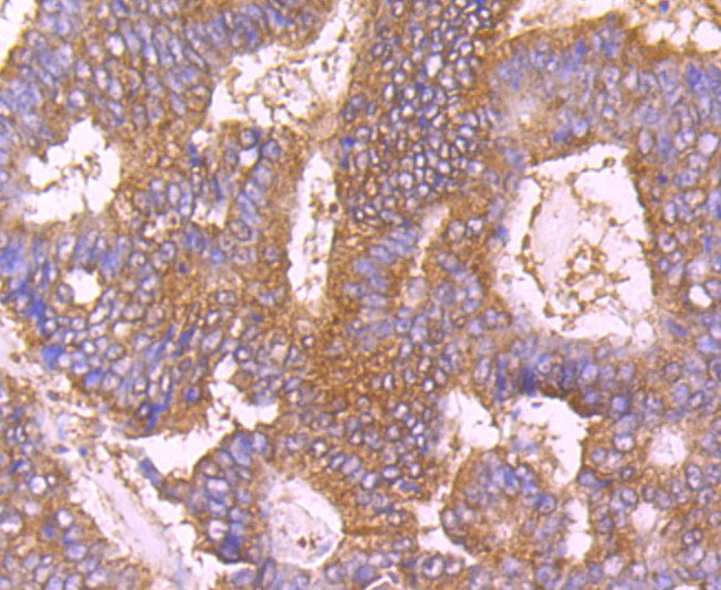 Immunohistochemical analysis of paraffin-embedded human colon cancer tissue using anti-Calpain 1 antibody. Counter stained with hematoxylin.