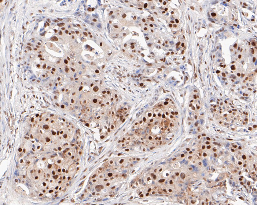 Immunohistochemical analysis of paraffin-embedded human breast carcinoma tissue using anti-MSH2 antibody. The section was pre-treated using heat mediated antigen retrieval with sodium citrate buffer (pH 6.0) for 20 minutes. The tissues were blocked in 5% BSA for 30 minutes at room temperature, washed with ddH2O and PBS, and then probed with the primary antibody (EM1801-04, 1/800)  for 30 minutes at room temperature. The detection was performed using an HRP conjugated compact polymer system. DAB was used as the chromogen. Tissues were counterstained with hematoxylin and mounted with DPX.