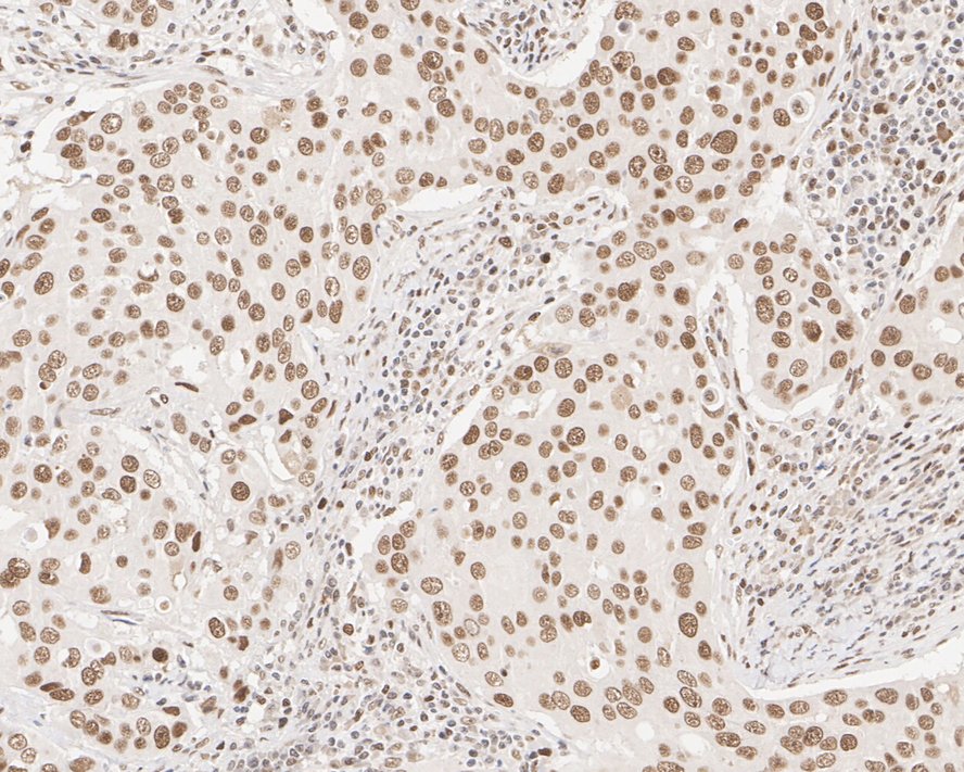 Immunohistochemical analysis of paraffin-embedded human breast cancer tissue with Mouse anti-MSH2 antibody (EM1801-05) at 1/1,000 dilution.<br />
<br />
The section was pre-treated using heat mediated antigen retrieval with sodium citrate buffer (pH 6.0) for 2 minutes. The tissues were blocked in 1% BSA for 20 minutes at room temperature, washed with ddH2O and PBS, and then probed with the primary antibody (EM1801-05) at 1/1,000 dilution for 1 hour at room temperature. The detection was performed using an HRP conjugated compact polymer system. DAB was used as the chromogen. Tissues were counterstained with hematoxylin and mounted with DPX.